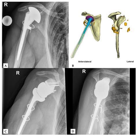 reverse shoulder arthroplasty orthobullets|How Reverse Shoulder Arthroplasty Works .